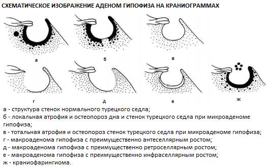 Аденомы гипофиза при остеопорозе спинки турецкого седла Аденомы гипофиза при остеопорозе спинки турецкого седла