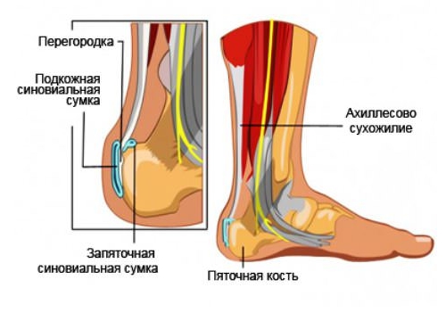 Ахиллобурсит Ахиллобурсит