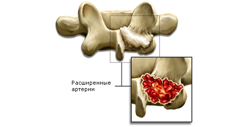 Схема аневризматической кисты Схема аневризматической кисты