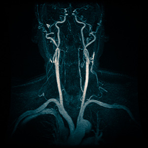Ангиография сосудов шеи Ангиография сосудов шеи