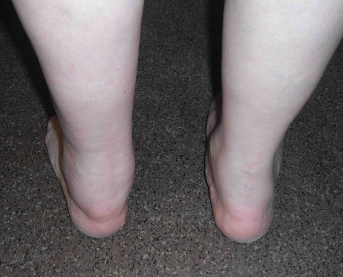 Опухание голеностопа при бурсите Опухание голеностопа при бурсите