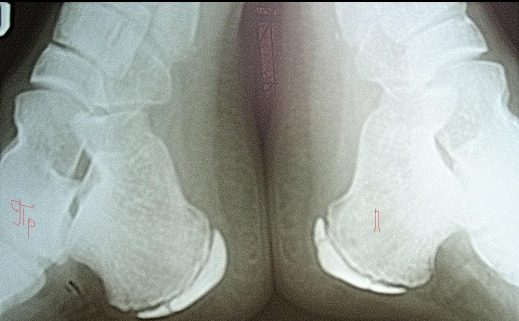 Апофизит бугра пяточной кости на рентгене Апофизит бугра пяточной кости на рентгене