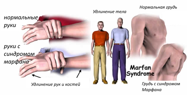 Арахнодактилия при синдроме Марфана Арахнодактилия при синдроме Марфана
