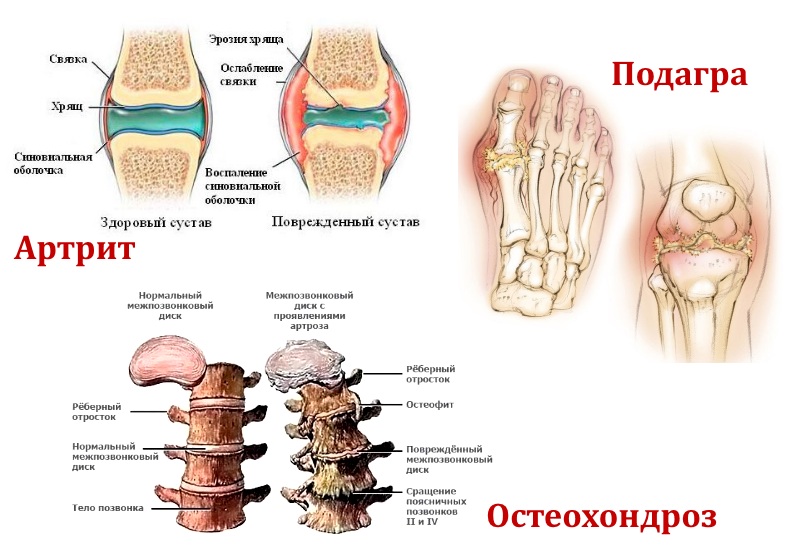 Артрит, подагра и остеохондроз Артрит, подагра и остеохондроз