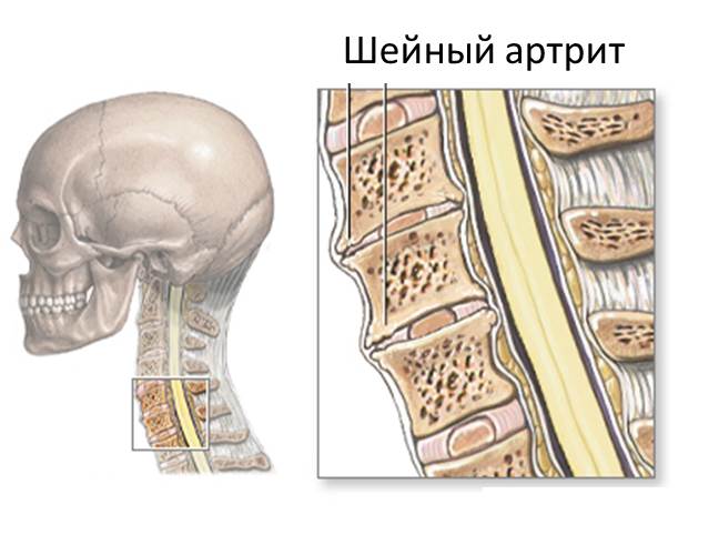 Артрит шейного отдела позвоночника Артрит шейного отдела позвоночника