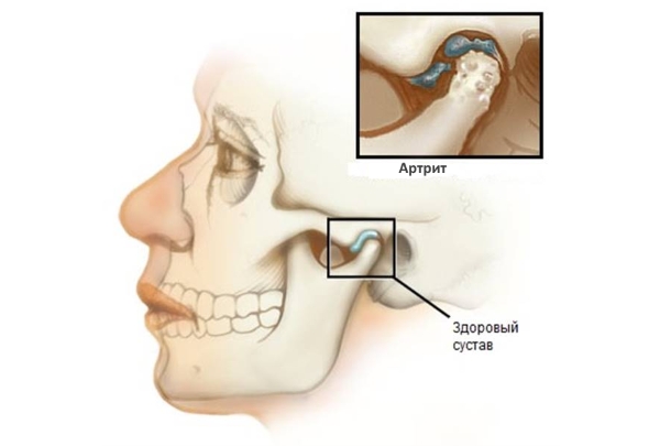 Схема артрита височно-нижнечелюстного сустава Схема артрита височно-нижнечелюстного сустава