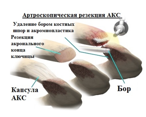 Артроскопическая резекция АКС