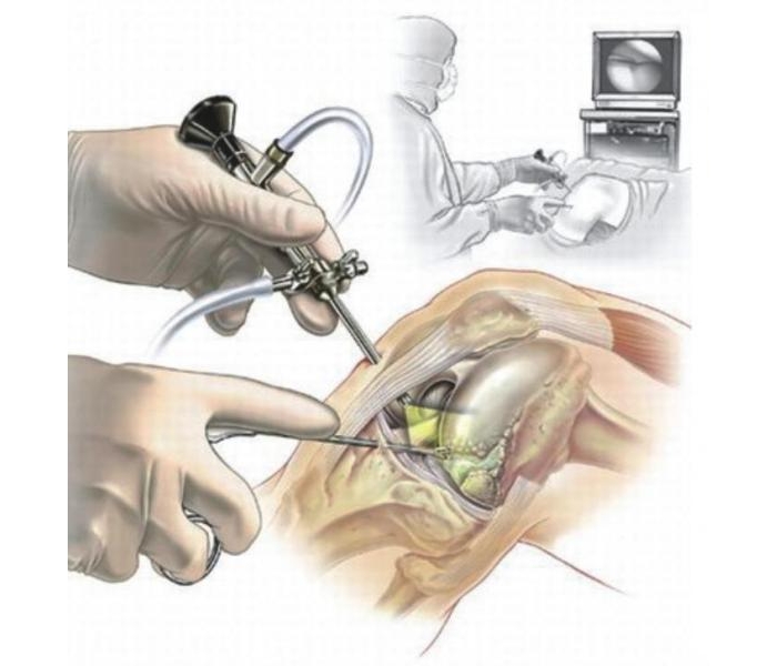 Артроскопия Артроскопия