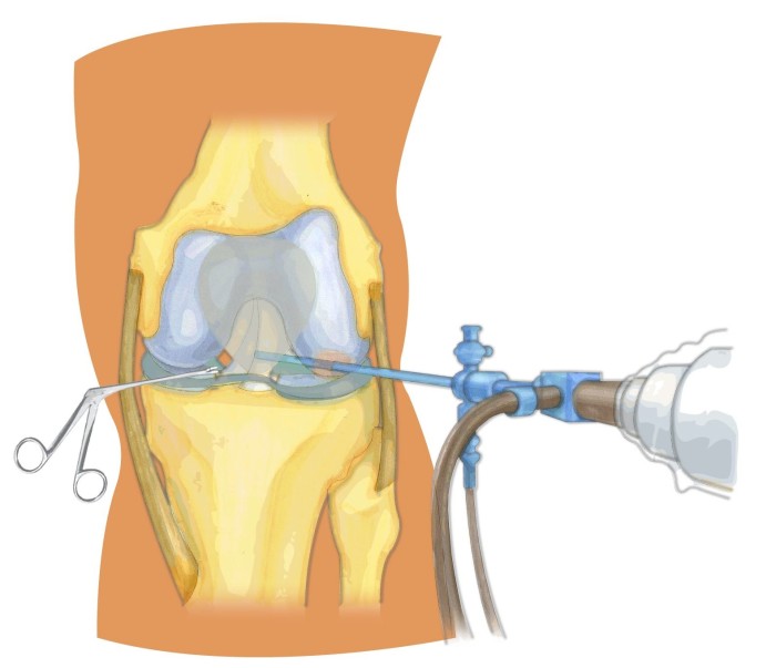 Артроскопия коленного сустава Артроскопия коленного сустава