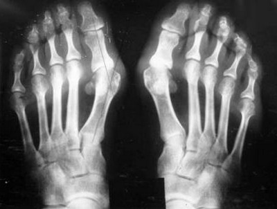 Артроз стопы на рентгене Артроз стопы на рентгене