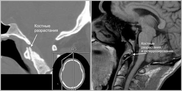 Артроз срединного атланто-аксиального сустава (сустав С1-2, сустав Крювелье) Артроз срединного атланто-аксиального сустава (сустав С1-2, сустав Крювелье)