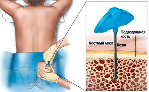 Биопсия костного мозга Биопсия костного мозга
