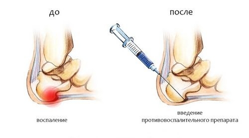 Блокада при пяточных шпорах Блокада при пяточных шпорах