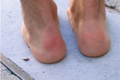 Фото пяток при болезни Хаглунда–Шинца Фото пяток при болезни Хаглунда–Шинца