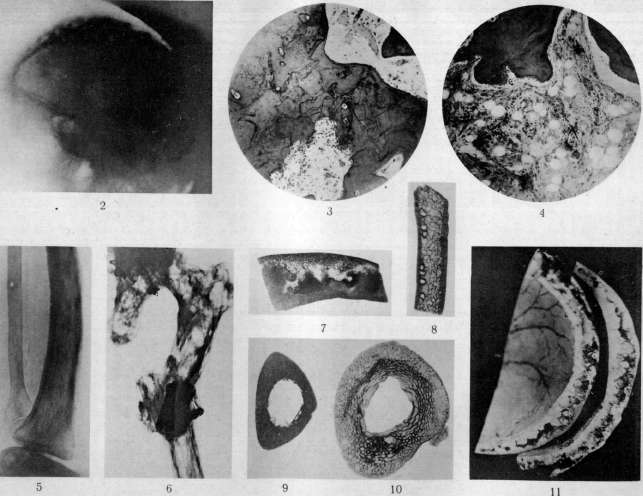 Деформирующий остит Деформирующий остит