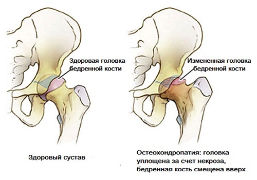 Болезнь Пертеса головки бедра Болезнь Пертеса головки бедра
