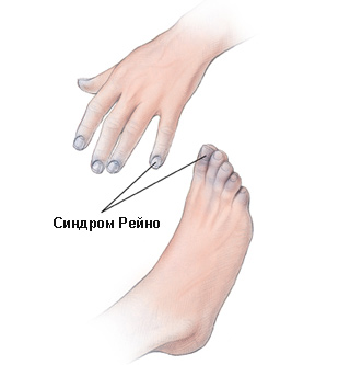Синдром Рейно Синдром Рейно