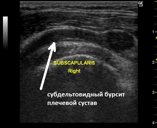 Бурсит плечевого сустава на УЗИ снимке Бурсит плечевого сустава на УЗИ снимке