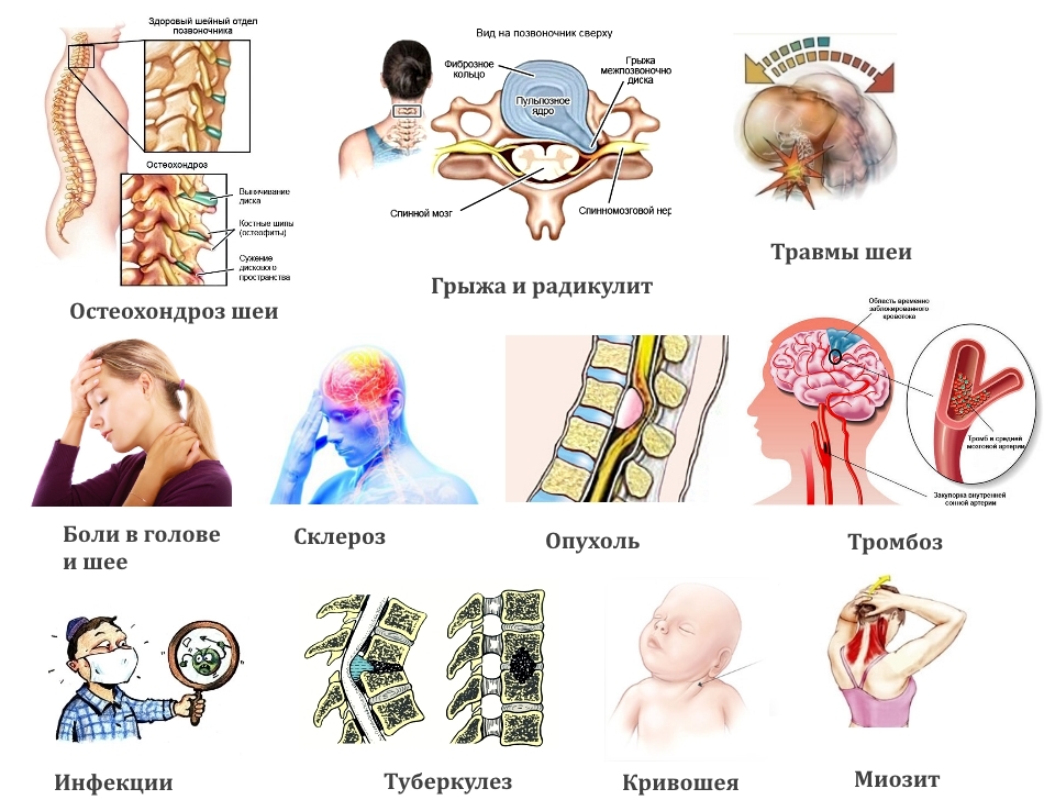 Частые показания для МРТ шеи Частые показания для МРТ шеи