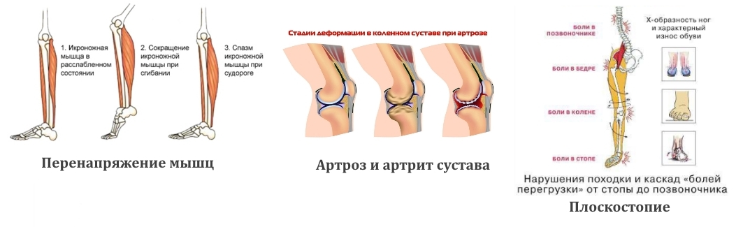Частые причины боли в ногах Частые причины боли в ногах