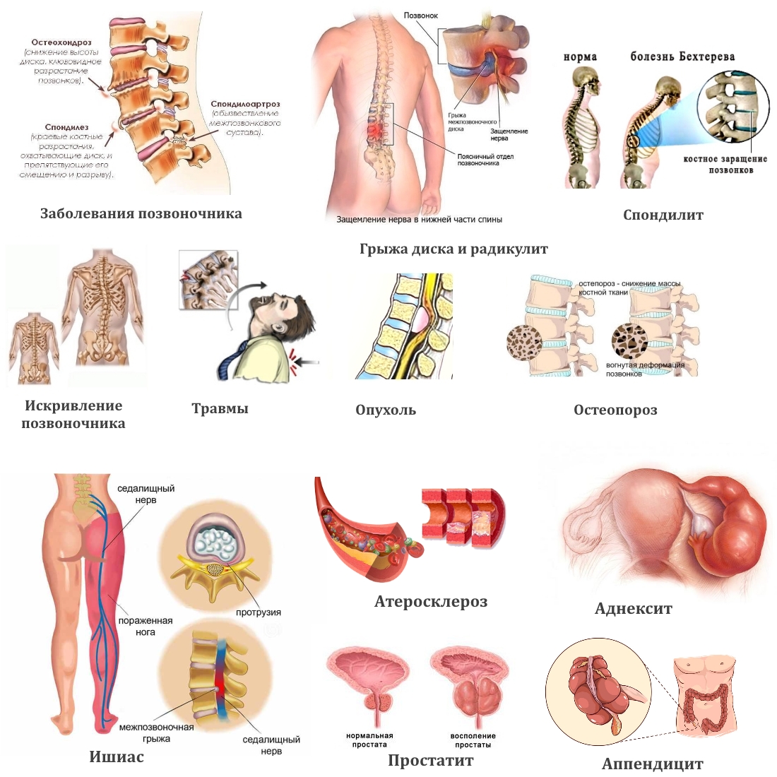 Заболевания — причины боли в пояснице Заболевания — причины боли в пояснице