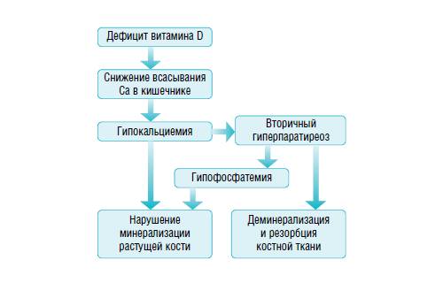 Дефицит витамина D Дефицит витамина D