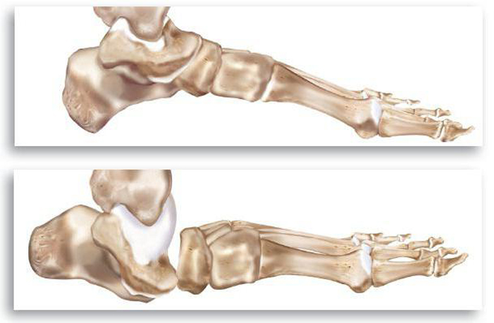 Деформация сустава Деформация сустава