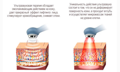 Действие ультразвуковой терапии Действие ультразвуковой терапии