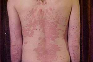 Дерматический миозит Дерматический миозит