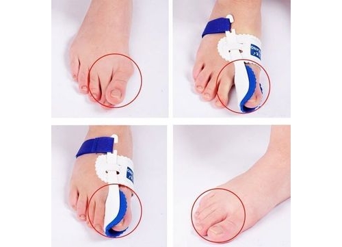 Эффект от фиксатора от косточки на ноге Эффект от фиксатора от косточки на ноге