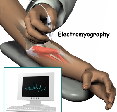 Электромиография мышц Электромиография мышц