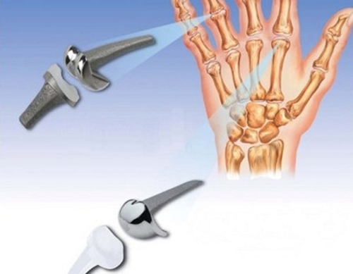 Эндопротезирование суставов кисти