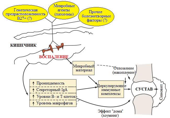 Энтеропатический артрит Энтеропатический артрит