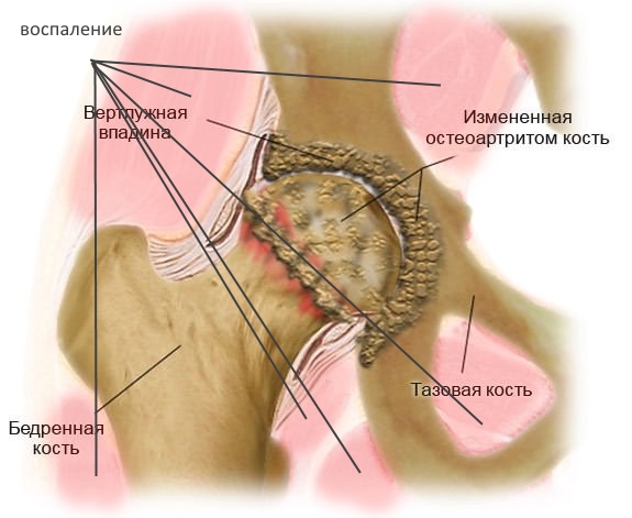 Энтезопатия тазобедренных суставов на фоне артрита Энтезопатия тазобедренных суставов на фоне артрита
