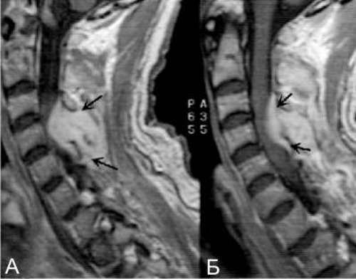 Эпидуральный абсцесс на КТ снимке Эпидуральный абсцесс на КТ снимке