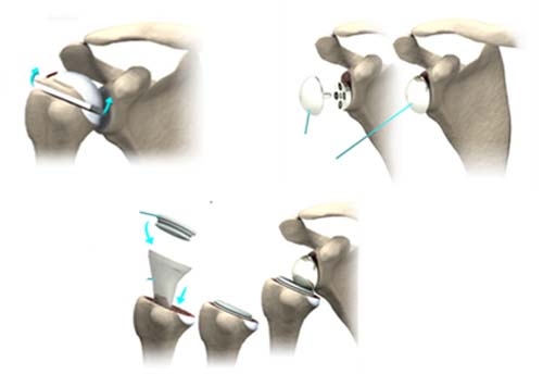 Этапы эндопротезирования реверсивным протезом