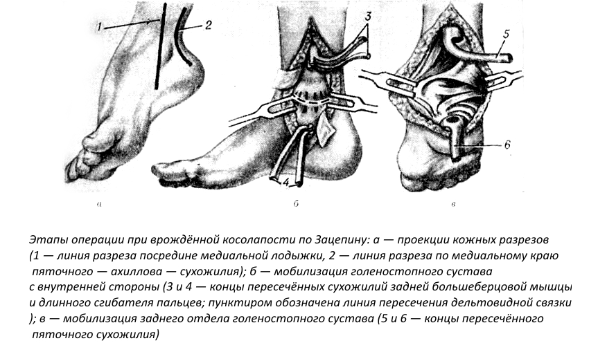 Этапы операции при врождённой косолапости по Зацепину Этапы операции при врождённой косолапости по Зацепину