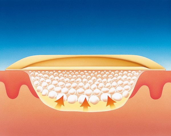 Высвобождение экссудата Высвобождение экссудата