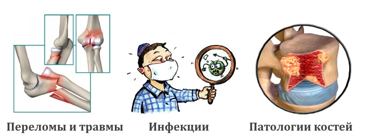 Факторы, способствующие появлению остеохондромы Факторы, способствующие появлению остеохондромы