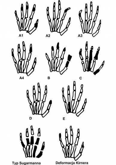 Формы брахидактилии Формы брахидактилии