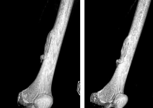 Гетеропластическая остеома Гетеропластическая остеома