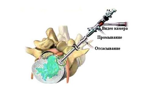 Гидропластика грыжи позвоночника Гидропластика грыжи позвоночника