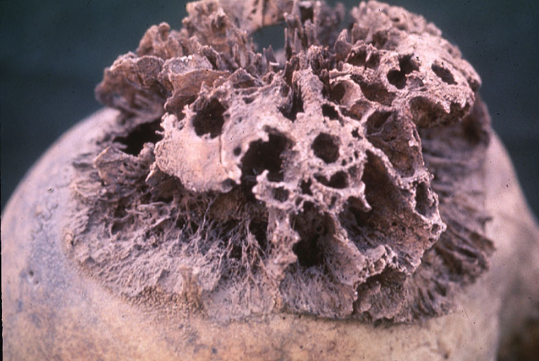 Гиперостоз лобной части черепа Гиперостоз лобной части черепа