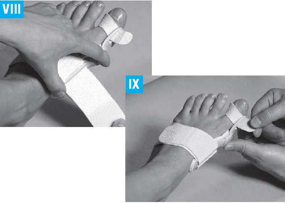 Надевание шины Hallufix Надевание шины Hallufix