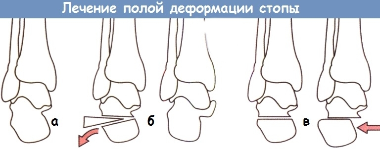 Хирургия конской стопы Хирургия конской стопы