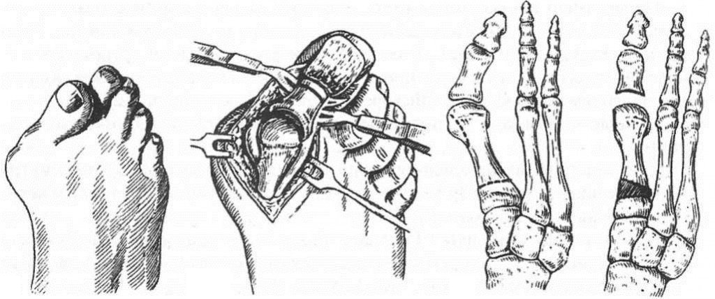 Хирургия для лечения шишек на ногах Хирургия для лечения шишек на ногах