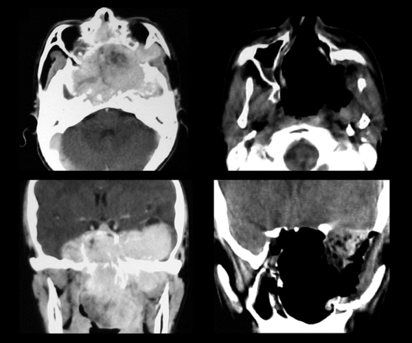 Хондрома основания черепа Хондрома основания черепа