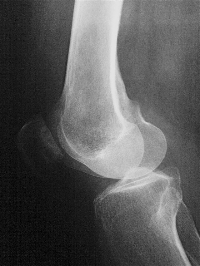 Хондромаляция надколенника на рентгене Хондромаляция надколенника на рентгене