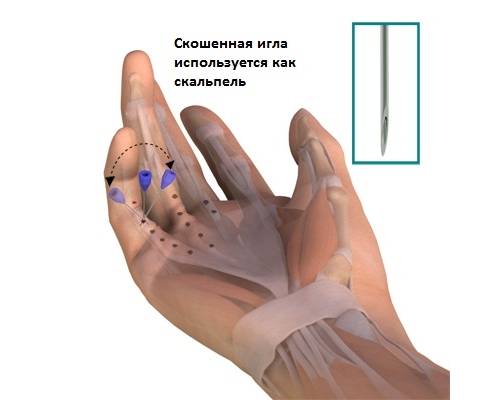 Игольчатая апоневротомия Игольчатая апоневротомия