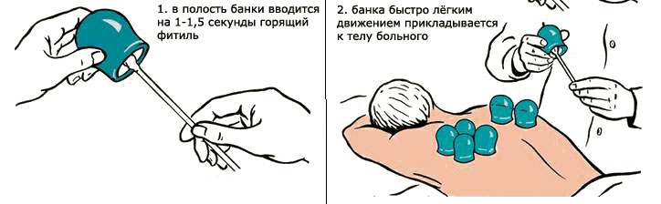 Инструкция по установке вакуумных банок с огнём Инструкция по установке вакуумных банок с огнём